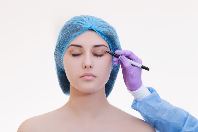 Класична блефаропластика