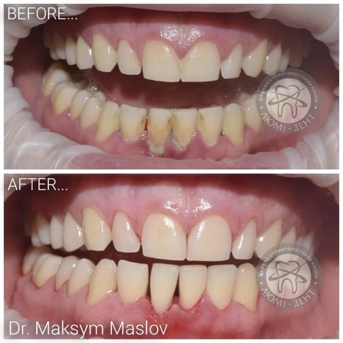 чистка зубов